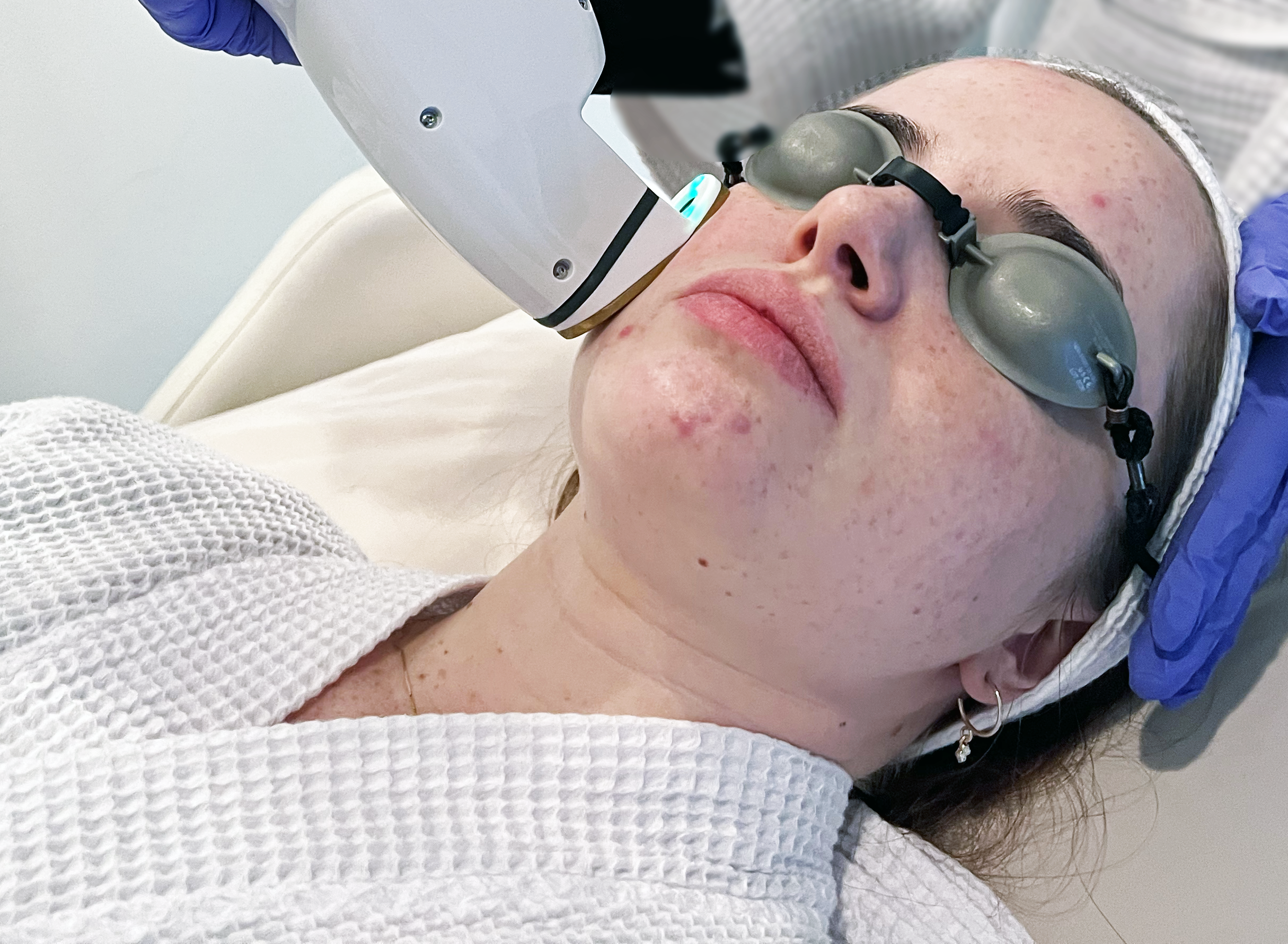 AviClear acne laser treatment