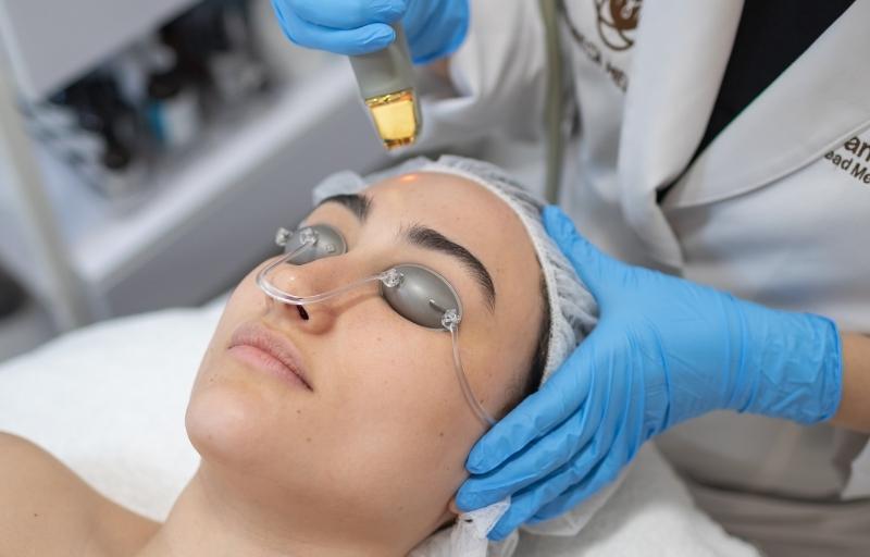 Laser Genesis acne treatments