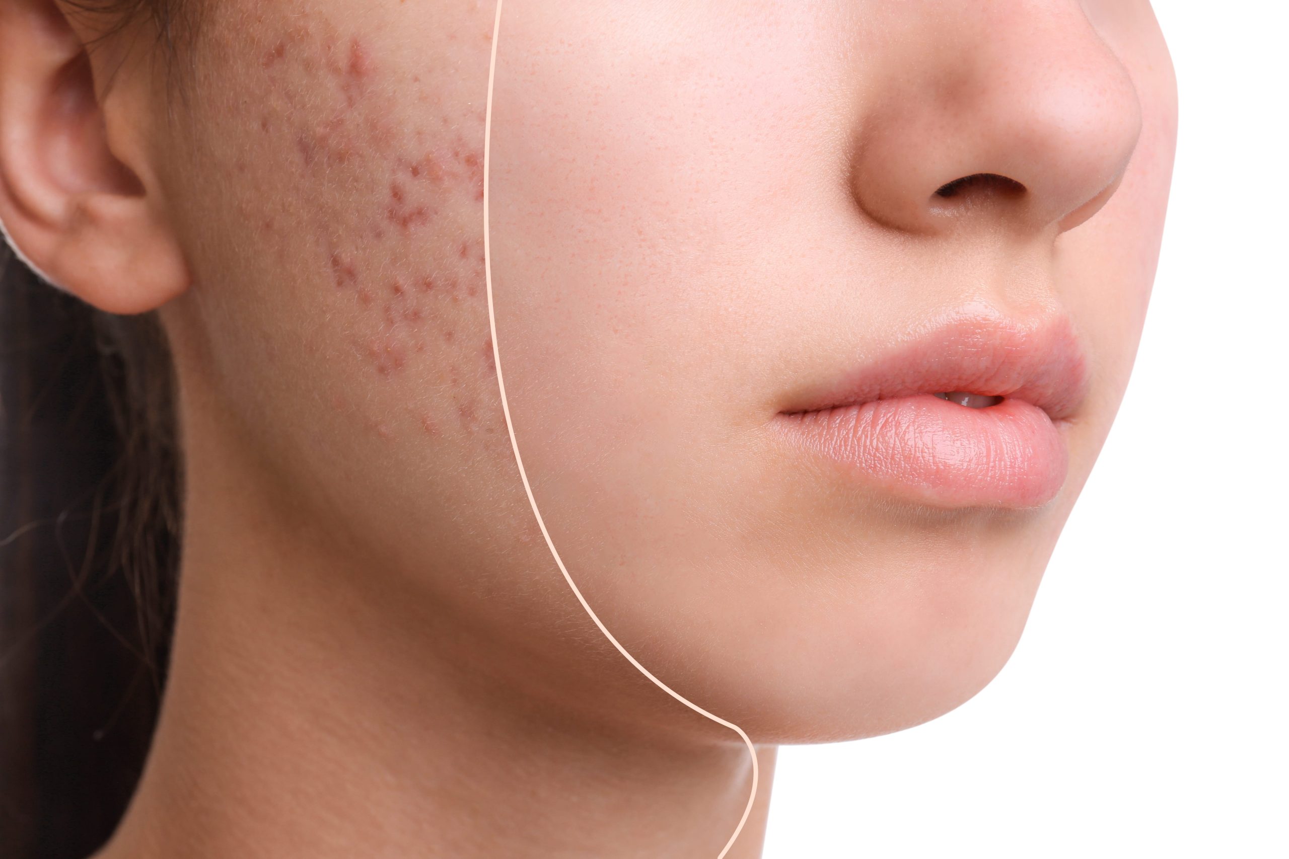 acne treatments before after side profile
