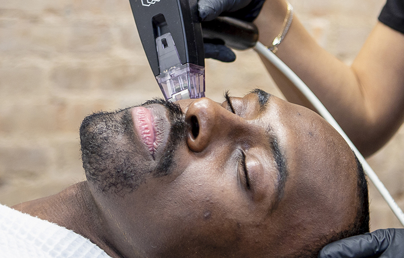 Morpheus 8 Treatment